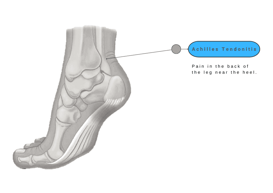 Achilles Tendonitis - Foot Pain