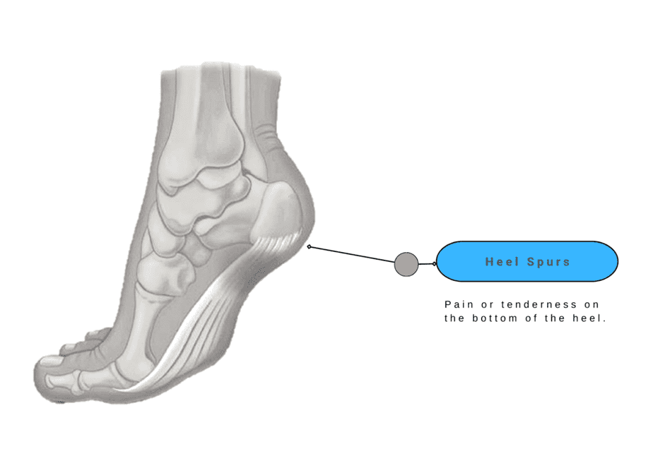 Heel Spurs - Foot Pain