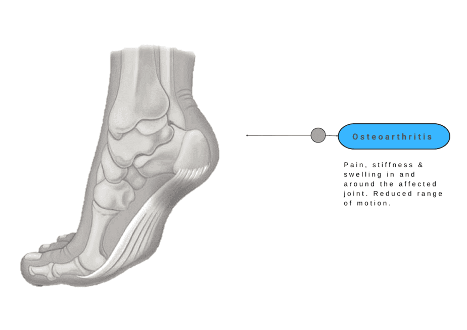 Osteoarthritis - Foot Pain