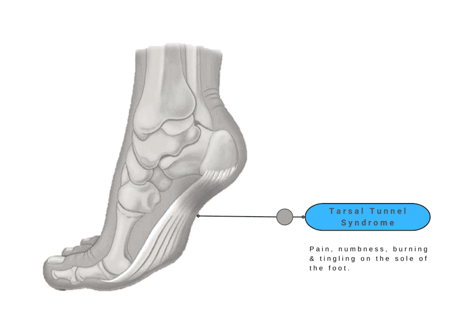 Posterior Tibial Tendon Dysfunction - Foot Pain